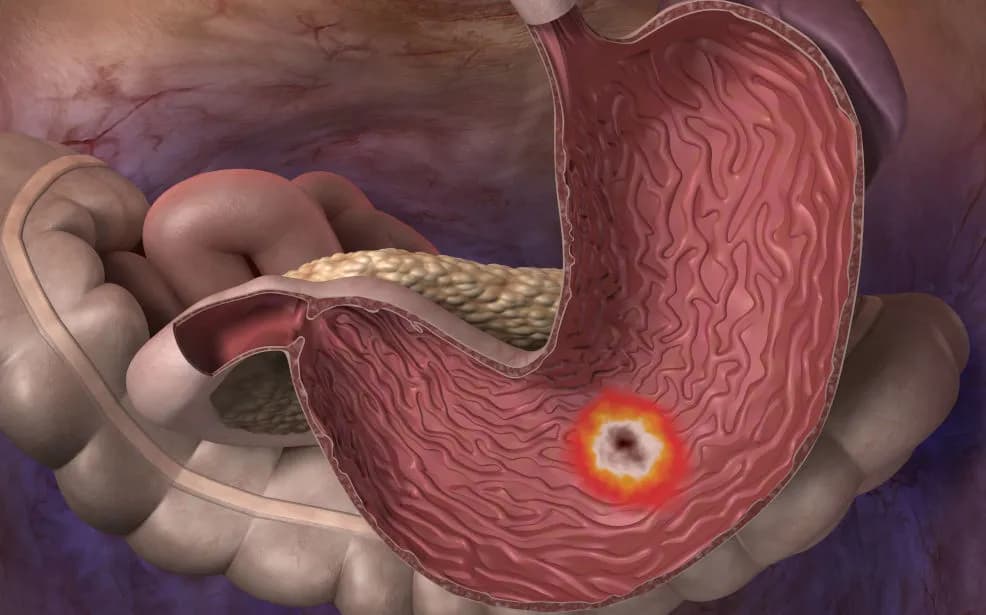 Jakie badanie na wrzody żołądka? Poznaj kluczowe metody diagnozy Jakie badanie na wrzody żołądka? Poznaj kluczowe metody diagnozy