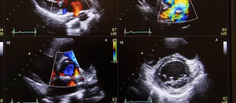 Jak odczytać wyniki badań Dopplera i zrozumieć ich znaczenie